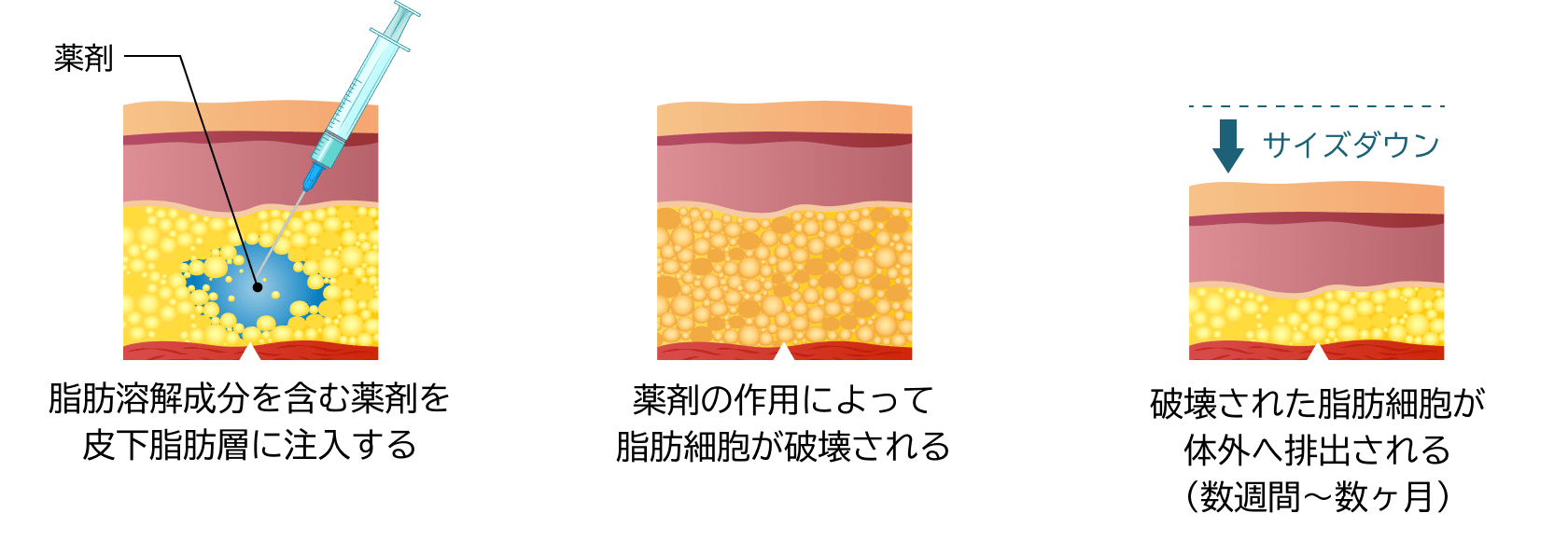 脂肪溶解注射のメカニズム