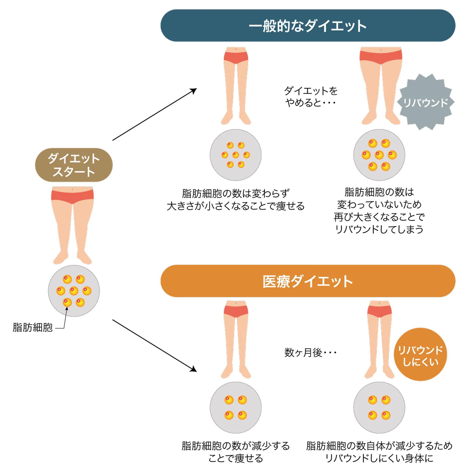 太もも痩せを実現する4つの治療メソッド