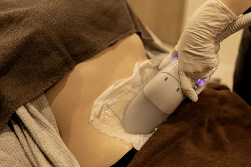 切らない施術で痛みやダウンタイムはほとんどなし