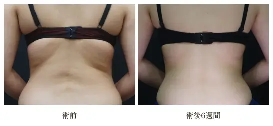 脂肪冷却の症例(背中・術後6週間)