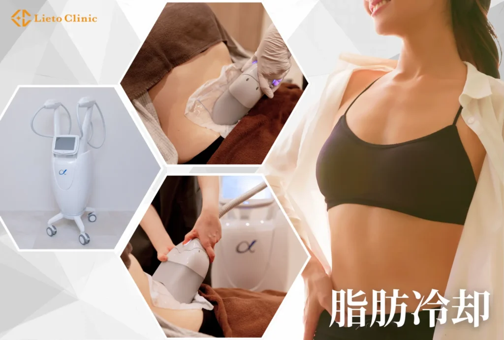 脂肪冷却