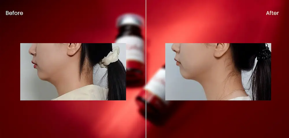 カベリン(脂肪溶解注射)女性・顔の症例