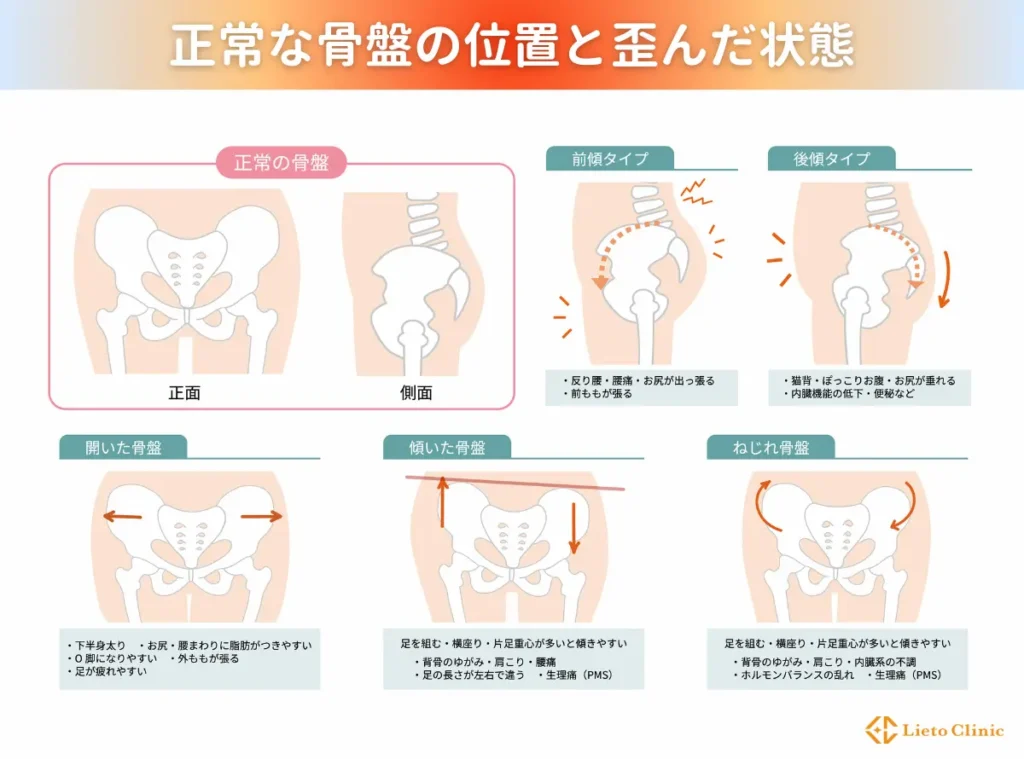 正常な骨盤の位置と歪んだ状態